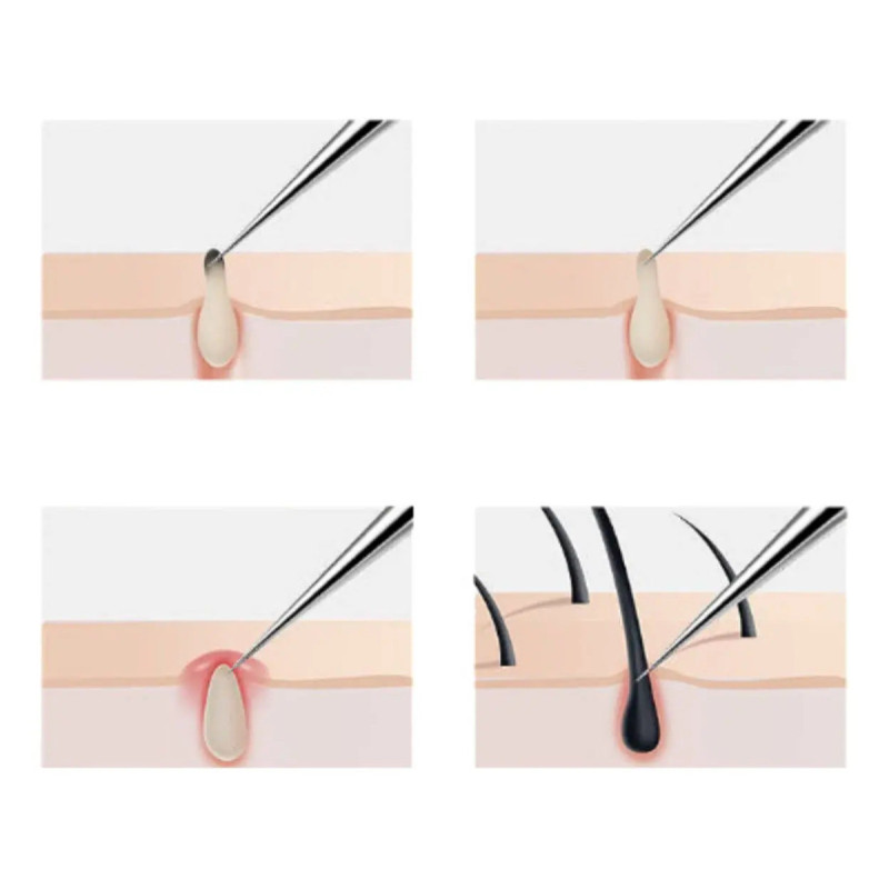 Pinzas Para Acne Y Espinillas 8 Piezas Cuidado De Piel - Imagen 6